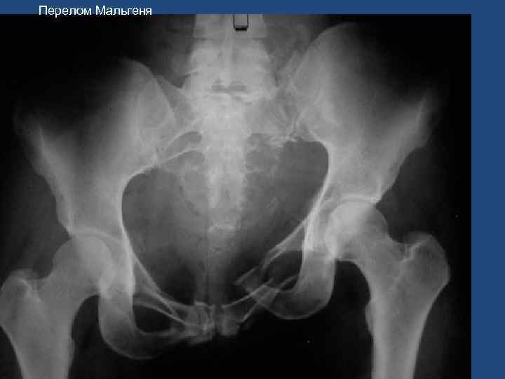 Перелом Мальгеня 46 