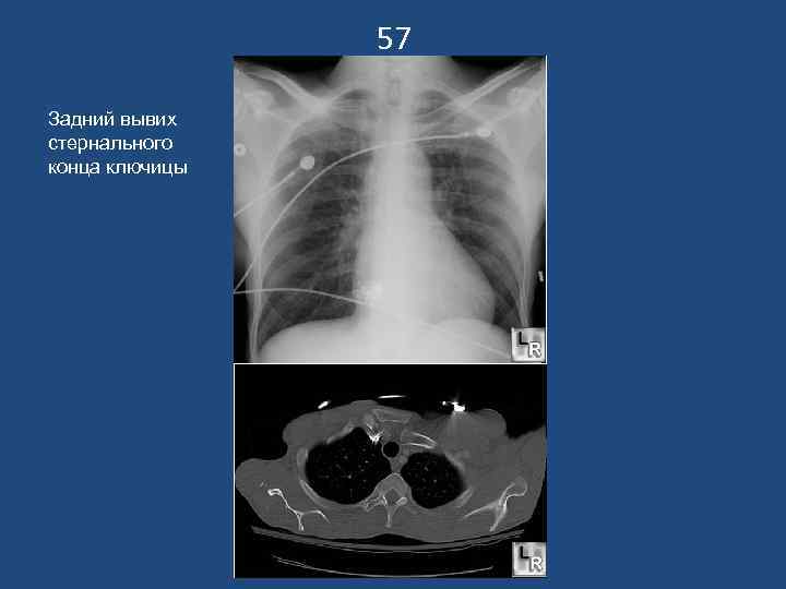 57 Задний вывих стернального конца ключицы 