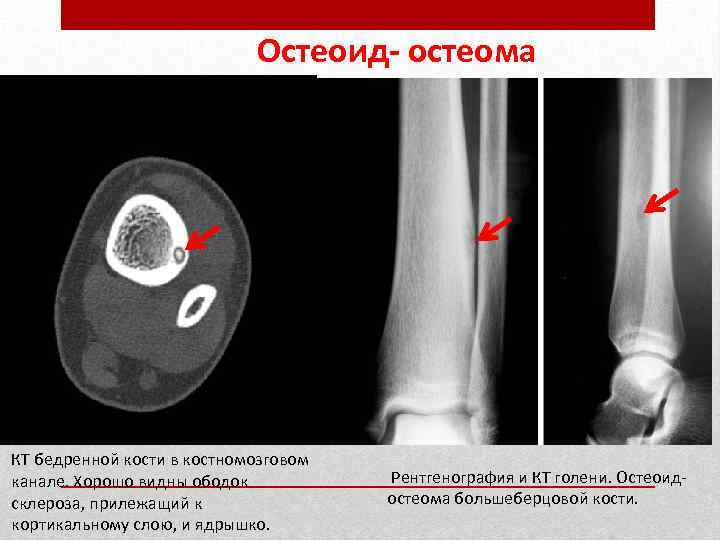 Остеома бедренной кости. Остеоид остеома рентген признаки. Остеома большеберцовой кости рентген. Остеома большеберцовой кости на кт.