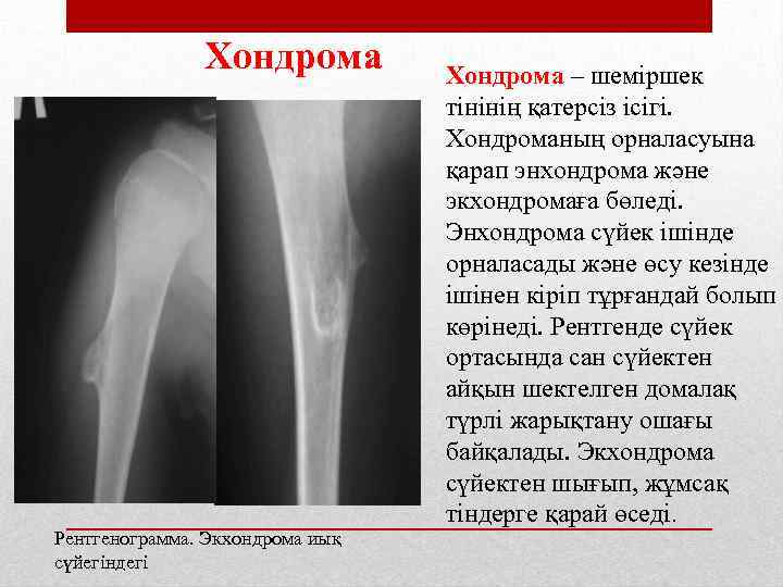 Экхондрома рентгенологическая картина