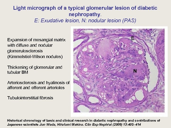 Light micrograph of a typical glomerular lesion of diabetic nephropathy. E: Exudative lesion, N: