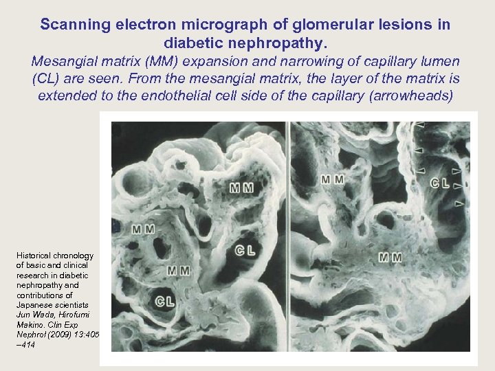 Scanning electron micrograph of glomerular lesions in diabetic nephropathy. Mesangial matrix (MM) expansion and