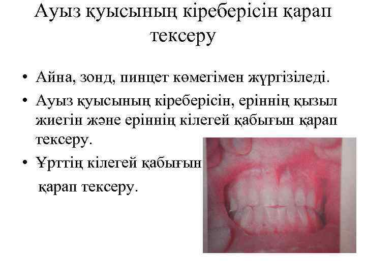 Ауыз қуысының кіреберісін қарап тексеру • Айна, зонд, пинцет көмегімен жүргізіледі. • Ауыз қуысының