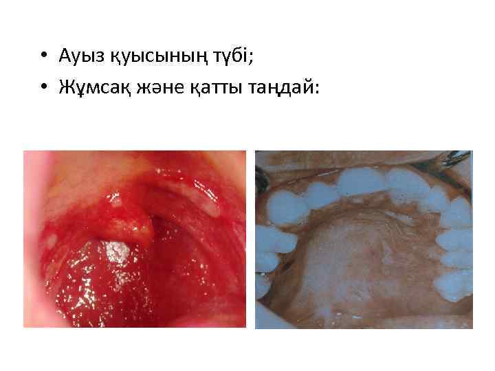  • Ауыз қуысының түбі; • Жұмсақ және қатты таңдай: 