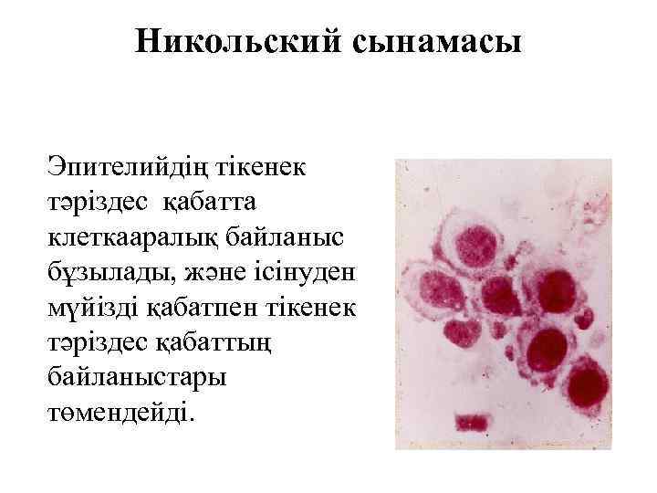Никольский сынамасы Эпителийдің тікенек тәріздес қабатта клеткааралық байланыс бұзылады, және ісінуден мүйізді қабатпен тікенек