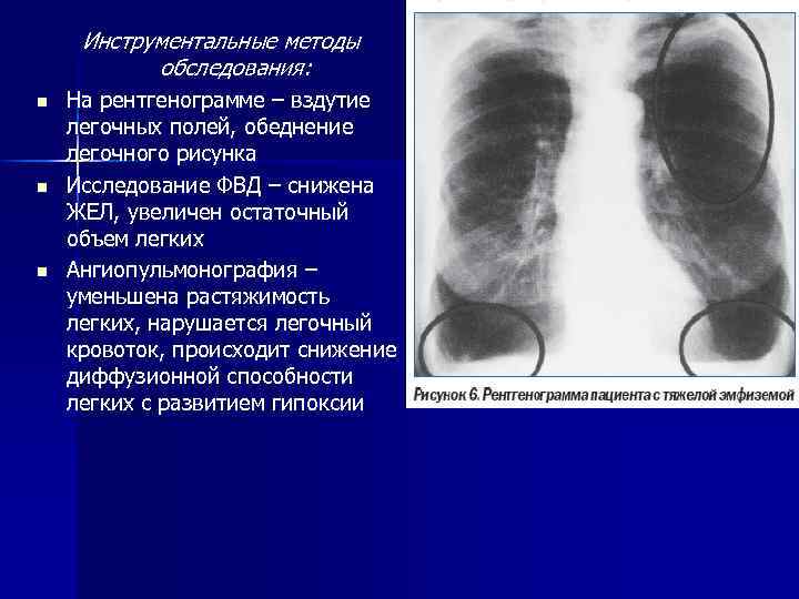 Легочный рисунок на рентгенограмме