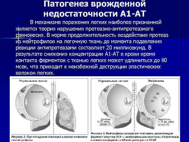 Дефицит альфа 1 антитрипсина у детей презентация