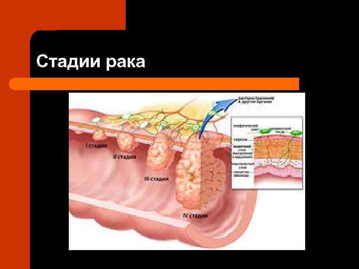 Сколько степеней рака