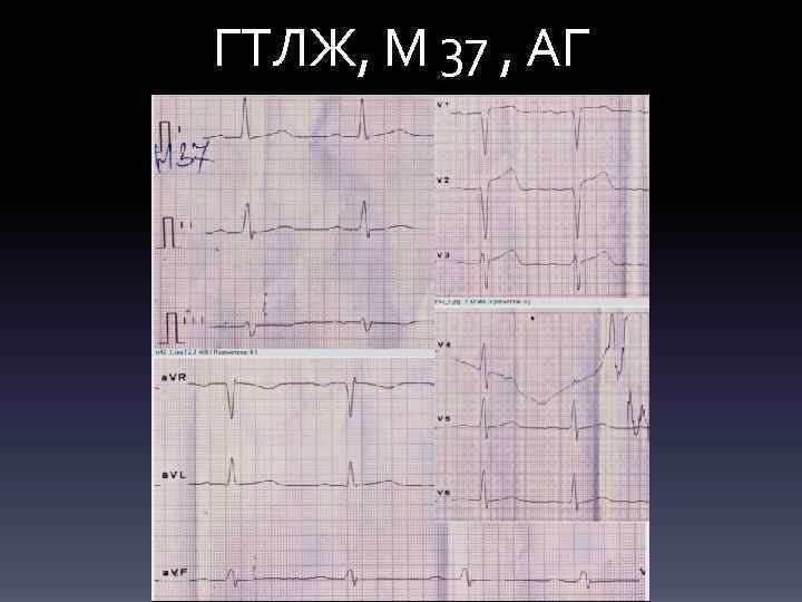ГТЛЖ, М 37 , АГ 