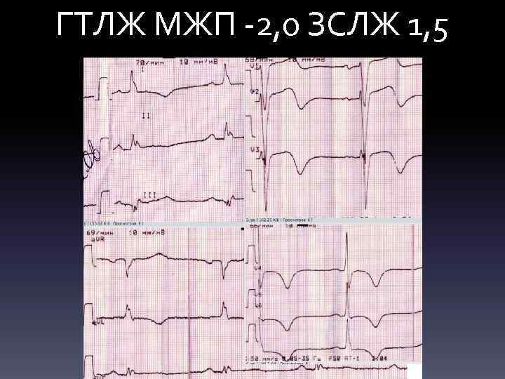 ГТЛЖ МЖП -2, 0 ЗСЛЖ 1, 5 