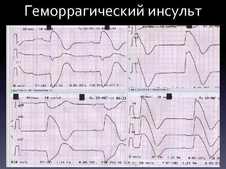 Геморрагический инсульт 