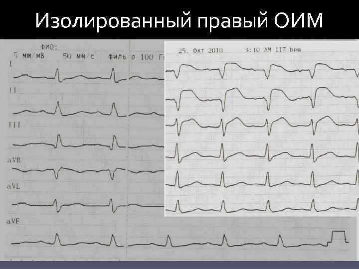 Изолированный правый ОИМ 