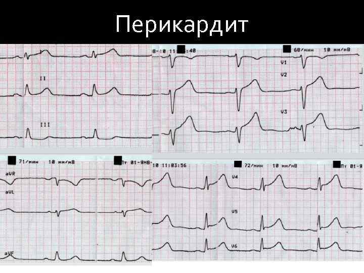 Перикардит 