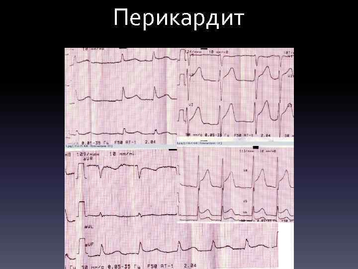 Перикардит 
