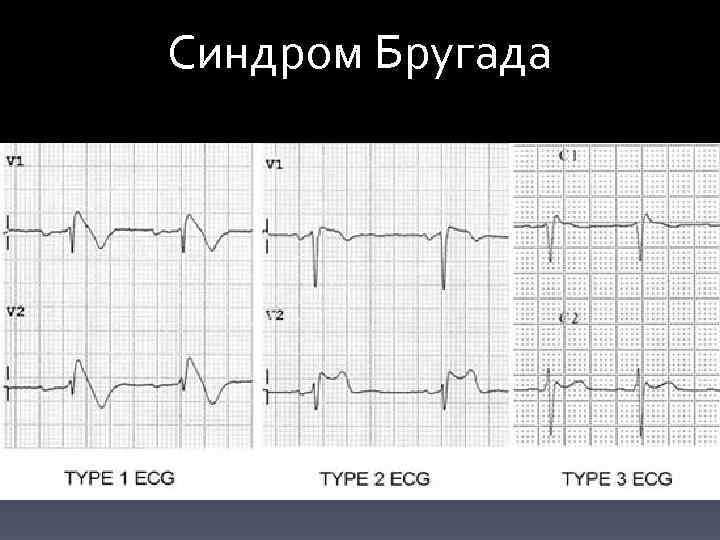 Синдром Бругада 