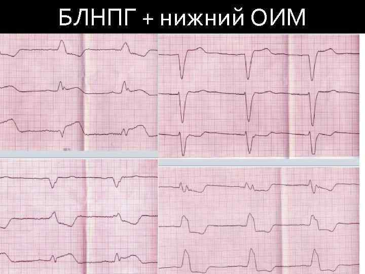 БЛНПГ + нижний ОИМ 