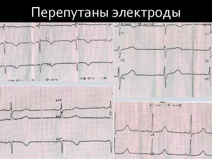Перепутаны электроды 