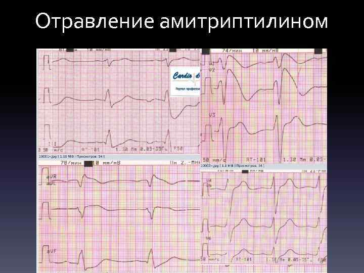 Отравление амитриптилином 