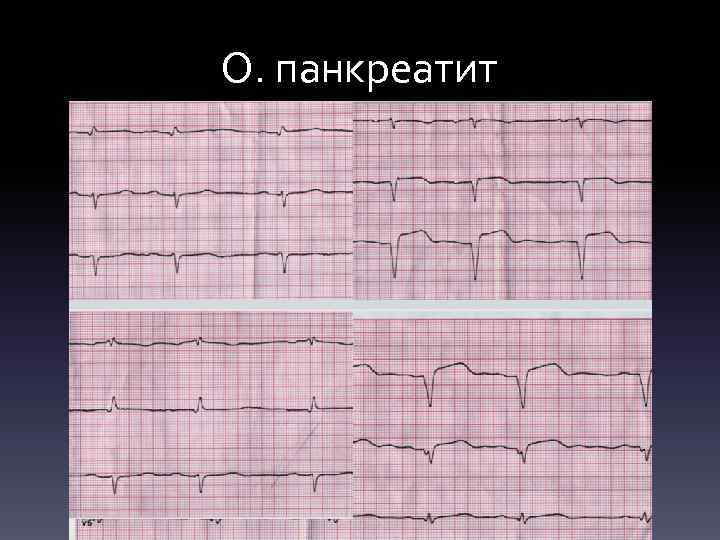 О. панкреатит 