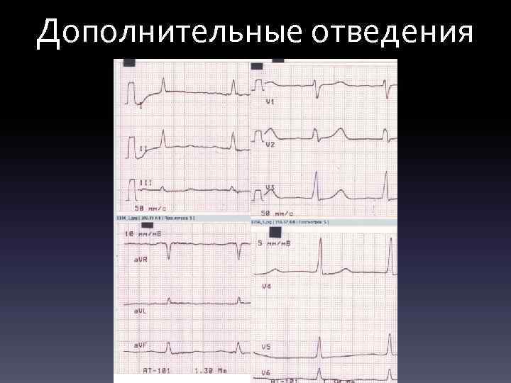 Дополнительные отведения 