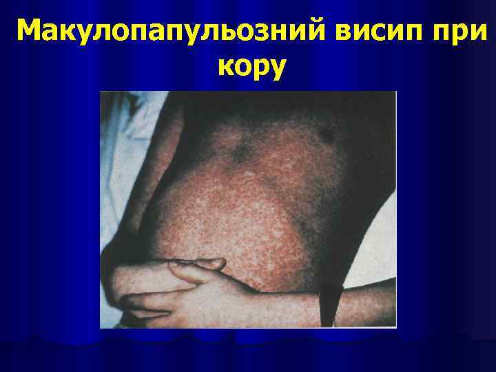 Макулопапульозний висип при кору 