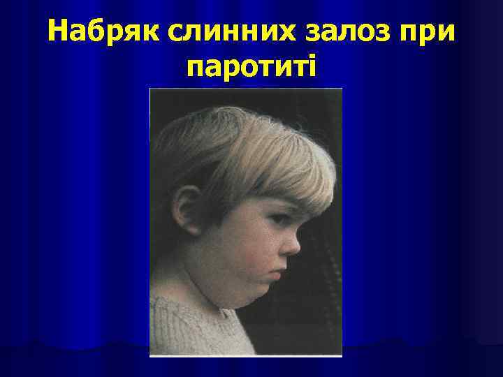 Набряк слинних залоз при паротиті 