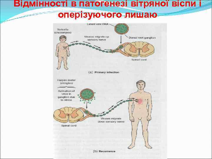 Відмінності в патогенезі вітряної віспи і оперізуючого лишаю 
