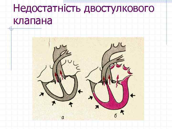 Недостатність двостулкового клапана 