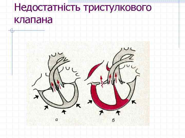 Недостатність тристулкового клапана 