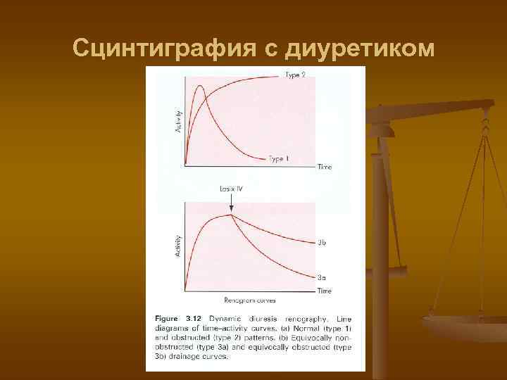 Сцинтиграфия с диуретиком 