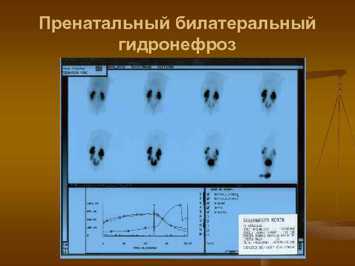 Пренатальный билатеральный гидронефроз 