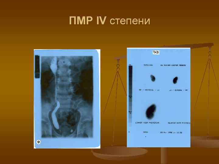 ПМР IV степени 