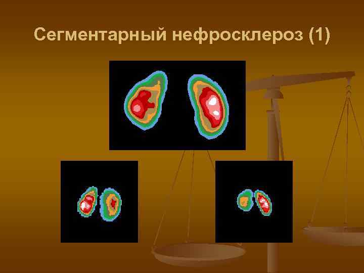 Сегментарный нефросклероз (1) 