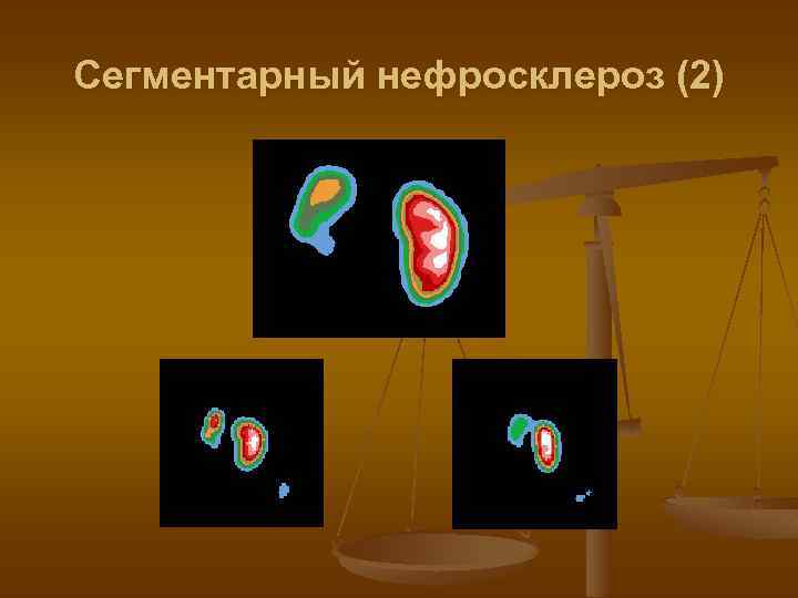 Сегментарный нефросклероз (2) 