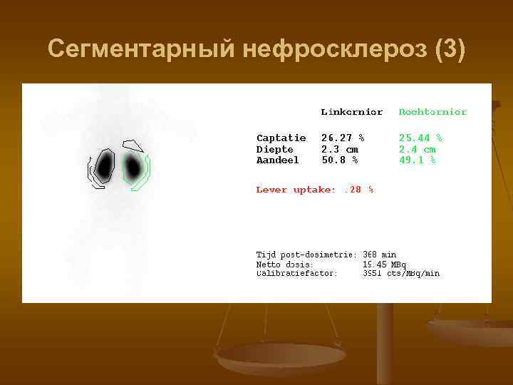 Сегментарный нефросклероз (3) 