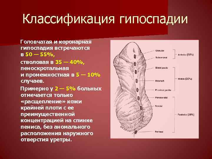 Классификация гипоспадии Головчатая и коронарная гипоспадия встречаются в 50 — 55%, стволовая в 35