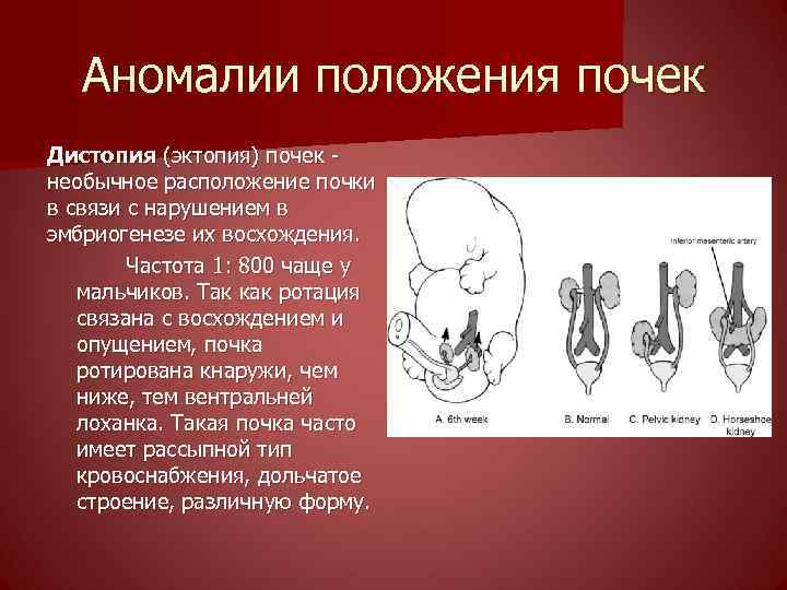 Аномалии мочеполовой системы презентация