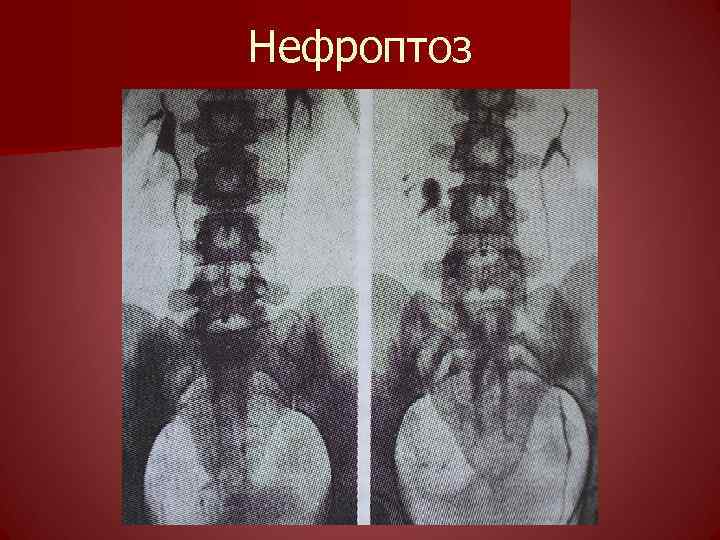 Нефроптоз 