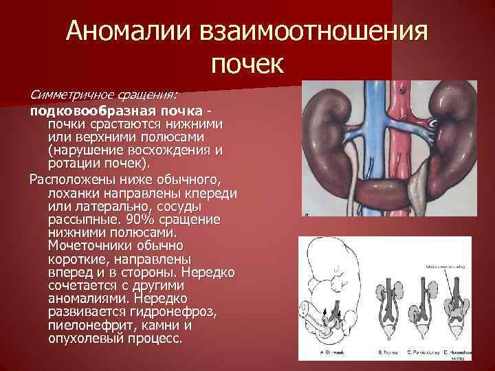 Аномалии мочеполовой системы презентация