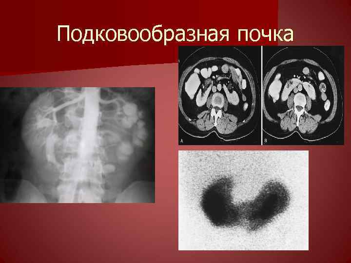 Аномалии члена. Аномалия развития почек подковообразная. Аномалии развития мочеполовой системы. Патология развития почек подковообразная. Аномалии развития мочеполовой системы урология.