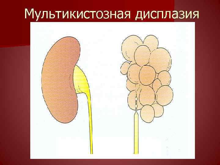 Мультикистозная дисплазия