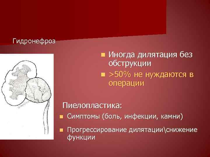 Гидронефроз Иногда дилятация без обструкции n >50% не нуждаются в операции n Пиелопластика: n