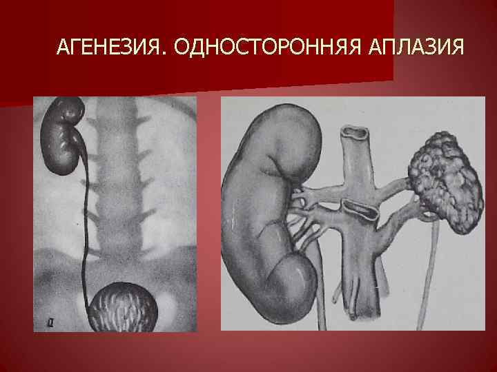 АГЕНЕЗИЯ. ОДНОСТОРОННЯЯ АПЛАЗИЯ 