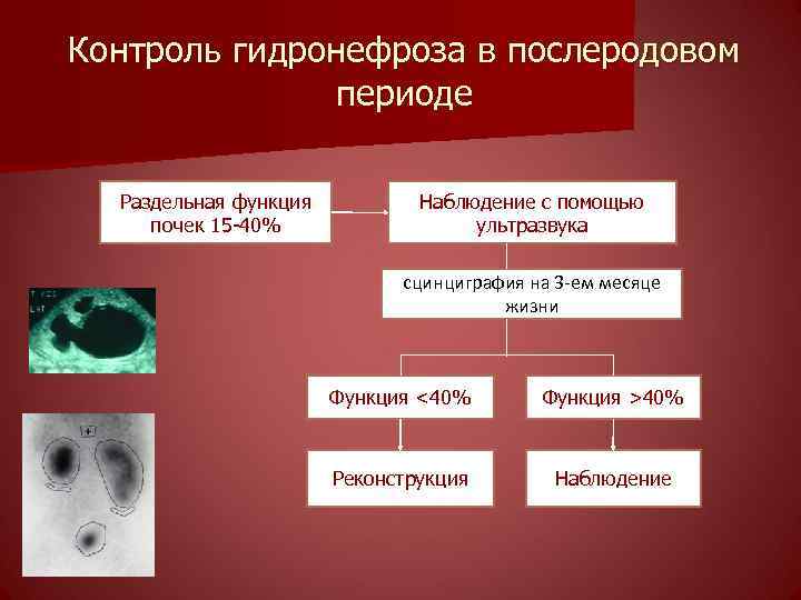 Контроль гидронефроза в послеродовом периоде Раздельная функция почек 15 -40% Наблюдение с помощью ультразвука