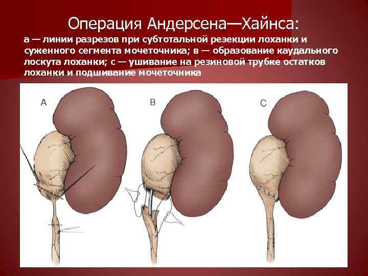 Операция Андерсена—Хайнса: а — линии разрезов при субтотальной резекции лоханки и суженного сегмента мочеточника;