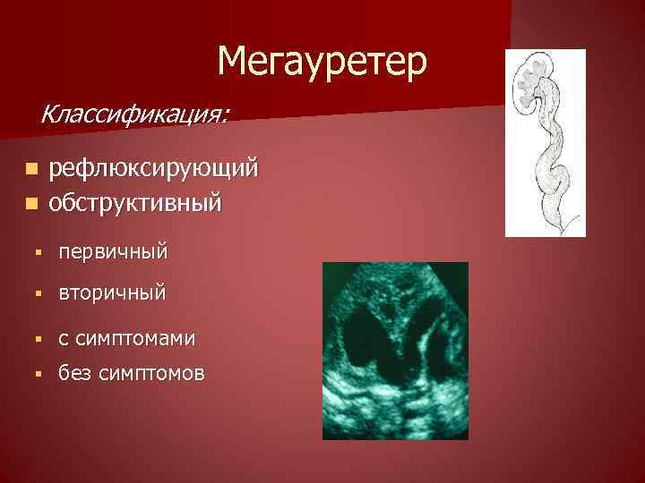 Мегауретер Классификация: рефлюксирующий n обструктивный n § первичный § вторичный § с симптомами §