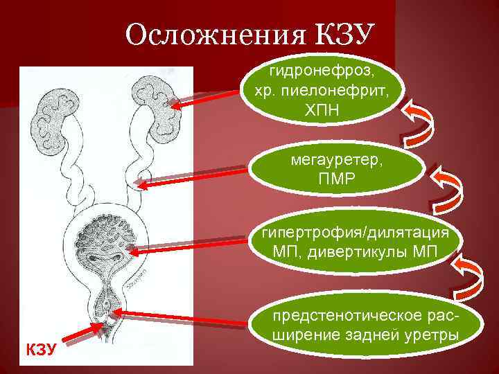  Осложнения КЗУ n гидронефроз, хр. пиелонефрит, ХПН мегауретер, ПМР гипертрофия/дилятация МП, дивертикулы МП