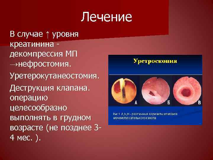 Лечение В случае ↑ уровня креатинина - декомпрессия МП →нефростомия. Уретерокутанеостомия. Деструкция клапана. операцию