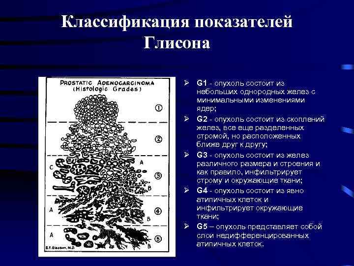 Классификация показателей Глисона Ø G 1 - опухоль состоит из небольших однородных желез с