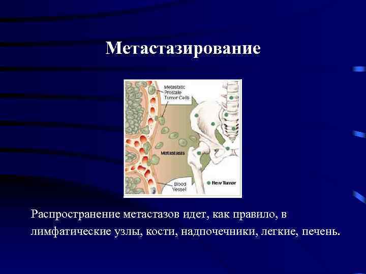 Метастазирование Распространение метастазов идет, как правило, в лимфатические узлы, кости, надпочечники, легкие, печень. 